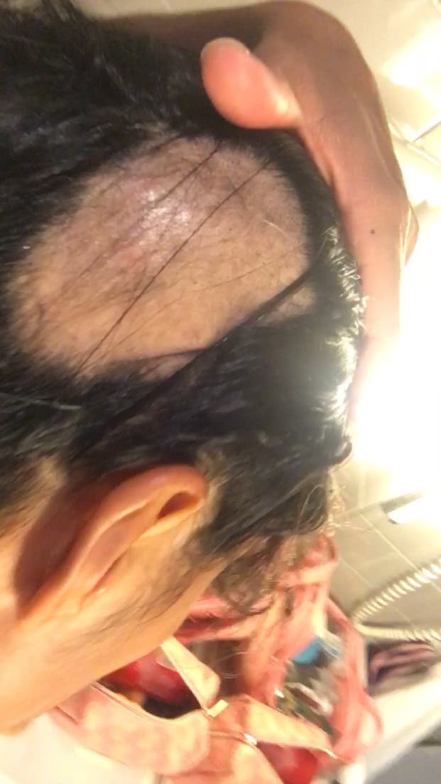 PHOTO: Courtesy of Brenda Martinez Brenda Martinez suffers from alopecia and the extreme hair loss can result from stress.