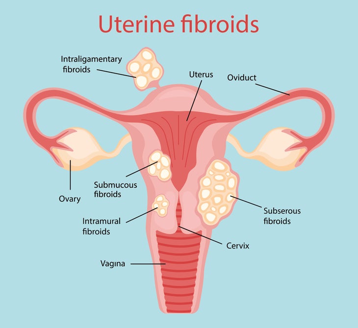 Best Exercises If You Have Fibroids